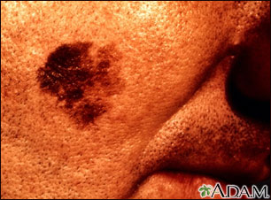 Skin cancer, close-up of lentigo maligna melanoma Skin cancer, close-up of lentigo maligna melanoma