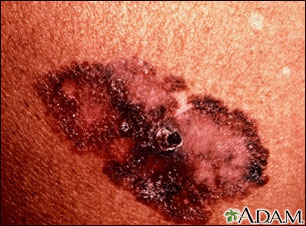 Skin cancer - melanoma superficial spreading Skin cancer - melanoma superficial spreading