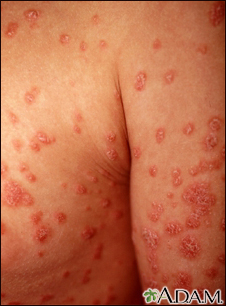 Psoriasis - guttate on the arms and chest Psoriasis - guttate on the arms and chest