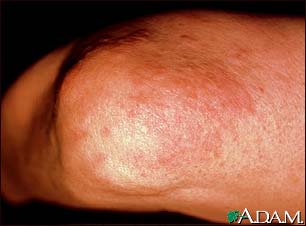 Granuloma annulare on the elbow Granuloma annulare on the elbow