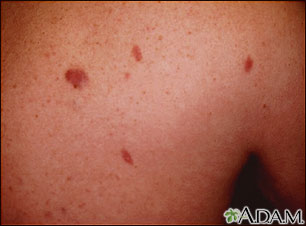 Kaposi sarcoma - close-up Kaposi sarcoma - close-up