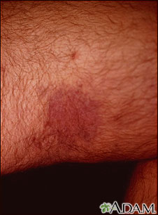Kaposi sarcoma on the thigh Kaposi sarcoma on the thigh