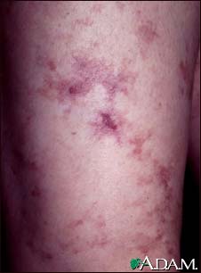 Livedo reticularis - close-up Livedo reticularis - close-up