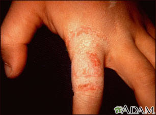 Ringworm - tinea manuum on the finger Ringworm - tinea manuum on the finger