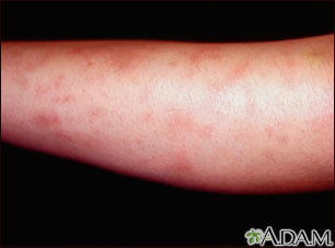 Erythema nodosum associated with sarcoidosis Erythema nodosum associated with sarcoidosis