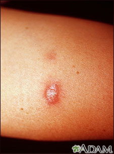 Sarcoidosis - close-up Sarcoidosis - close-up