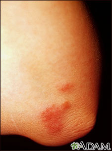 Sarcoidosis on the elbow Sarcoidosis on the elbow
