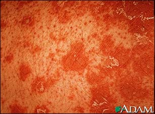 Pityriasis rubra pilaris - close-up Pityriasis rubra pilaris - close-up