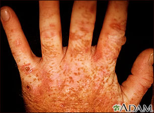 Porphyria cutanea tarda on the hands Porphyria cutanea tarda on the hands