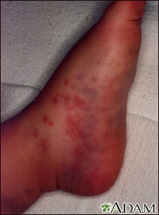 Henoch-Schonlein purpura on an infant's foot Henoch-Schonlein purpura on an infant's foot