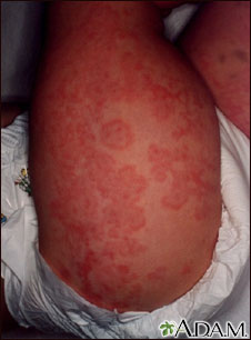Henoch-Schonlein purpura on an infant's legs Henoch-Schonlein purpura on an infant's legs