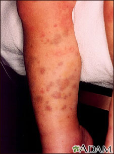 Henoch-Schonlein purpura on the legs Henoch-Schonlein purpura on the legs