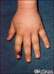 Snake bite on the finger Snake bite on the finger