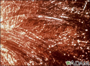 Head louse infestation - scalp Head louse infestation - scalp