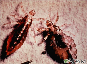 Lice, body with stool (Pediculus humanus) Lice, body with stool (Pediculus humanus)