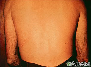 Strongyloidiasis, creeping eruption on the back Strongyloidiasis, creeping eruption on the back