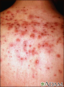 Acne - close-up of cysts on the back Acne - close-up of cysts on the back