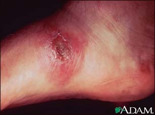 Leishmania panamensis on the foot Leishmania panamensis on the foot