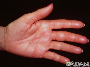 Herpes zoster (shingles) on the hand Herpes zoster (shingles) on the hand