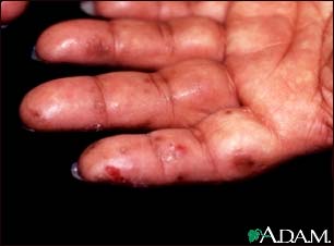 Dermatitis herpetiformis on the hand Dermatitis herpetiformis on the hand