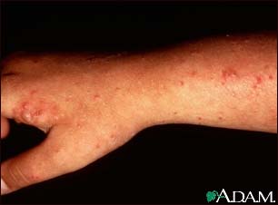 Polymorphic light eruption on the arm Polymorphic light eruption on the arm
