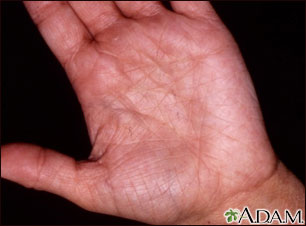 Hyperlinearity in atopic dermatitis Hyperlinearity in atopic dermatitis