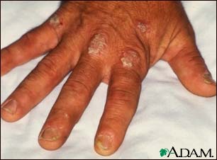 Psoriasis on the knuckles Psoriasis on the knuckles