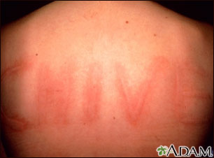 Dermatographism on the back Dermatographism on the back