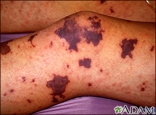Meningococcemia on the leg Meningococcemia on the leg
