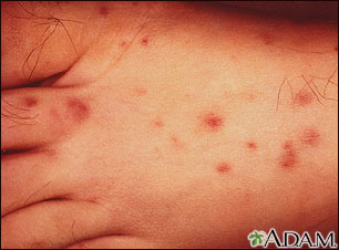 Rocky mountain spotted fever on the foot Rocky mountain spotted fever on the foot