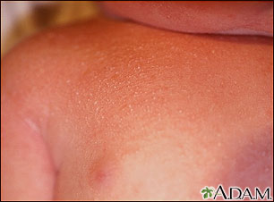 Miliaria crystallina - close-up Miliaria crystallina - close-up