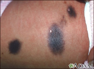 Congenital nevus on the abdomen Congenital nevus on the abdomen