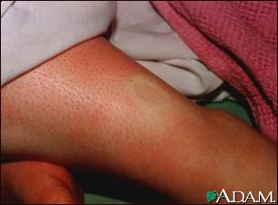 Pitting edema on the leg Pitting edema on the leg