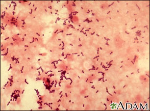 Pneumococcal pneumonia Pneumococcal pneumonia