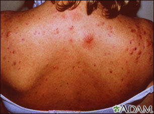 Acne on the back Acne on the back