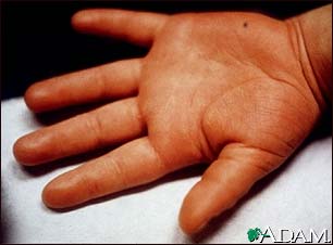 Kawasaki disease - edema of the hand Kawasaki disease - edema of the hand