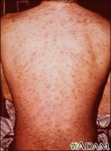 Drug rash on the back Drug rash on the back