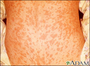 Measles on the back Measles on the back
