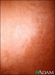 Hyperpigmentation 2 Hyperpigmentation 2