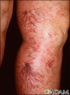 Telangiectasia - legs Telangiectasia - legs