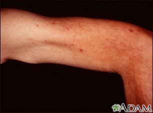 Telangiectasias - upper arm Telangiectasias - upper arm