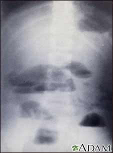 Small bowel obstruction - X-ray Small bowel obstruction - X-ray