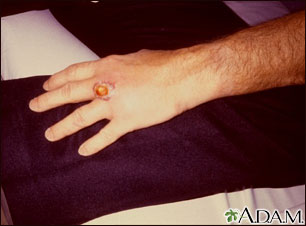 Brown recluse spider bite on the hand Brown recluse spider bite on the hand