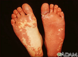 Sturge-Weber syndrome - soles of feet Sturge-Weber syndrome - soles of feet