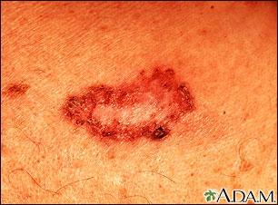 Basal cell carcinoma - close-up Basal cell carcinoma - close-up