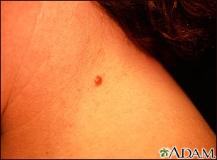 Irritated Seborrheic Kerotosis - neck Irritated Seborrheic Kerotosis - neck