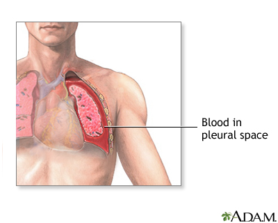 Hemothorax Hemothorax