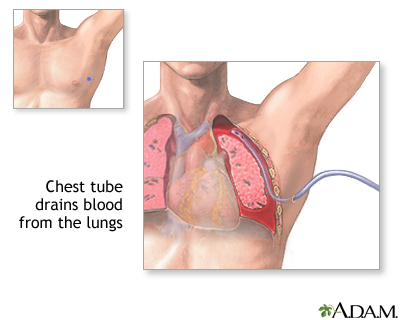 Chest tube insertion Chest tube insertion