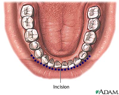 Incision Incision