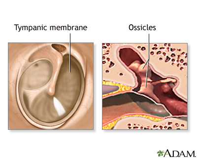 Eardrum repair - series Eardrum repair - series